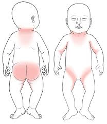 sudamina neonato suggerimenti rimedi e cure